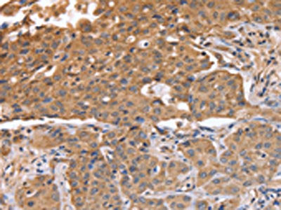 The image on the left is immunohistochemistry of paraffin-embedded Human lung cancer tissue using ABCB6 Antibody(ABCB6 Antibody) at dilution 1/15, on the right is treated with fusion protein. (Original magnification: ×200)