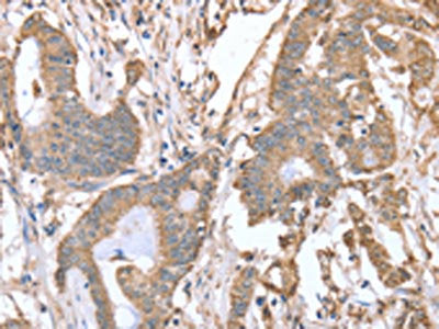 The image on the left is immunohistochemistry of paraffin-embedded Human colon cancer tissue using the antibody Antibody) at dilution 1/15, on the right is treated with fusion protein. (Original magnification: ×200)