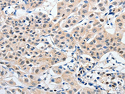 The image on the left is immunohistochemistry of paraffin-embedded Human lung cancer tissue using P2RY6 Antibody(P2RY6 Antibody) at dilution 1/80, on the right is treated with synthetic peptide. (Original magnification: ×200)Rabbit anti-Human P2RY6 Polyclonal Antibody