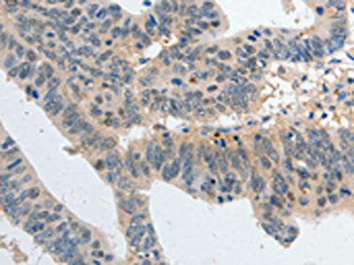 The image on the left is immunohistochemistry of paraffin-embedded Human colon cancer tissue using the antibody Antibody) at dilution 1/80, on the right is treated with synthetic peptide. (Original magnification: ×200)Rabbit anti-Human P2RY6 Polyclonal Antibody