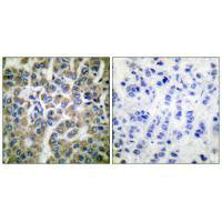 Immunohistochemical analysis of paraffin-embedded human breast carcinoma tissue using HSP10 antibody.Rabbit anti-Human HSPE1 Polyclonal Antibody