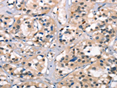 The image on the left is immunohistochemistry of paraffin-embedded Human thyroid cancer tissue using NDNL2 Antibody(NDNL2 Antibody) at dilution 1/40, on the right is treated with synthetic peptide. (Original magnification: ×200)Rabbit anti-Human NDNL2 Polyclonal Antibody