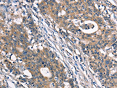 The image on the left is immunohistochemistry of paraffin-embedded Human gastic cancer tissue using the antibody Antibody) at dilution 1/40, on the right is treated with synthetic peptide. (Original magnification: ×200)Rabbit anti-Human NDNL2 Polyclonal Antibody