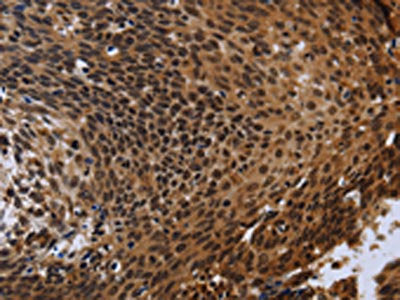 The image is immunohistochemistry of paraffin-embedded Human cervical cancer using the antibody Antibody) at dilution 1/40. (Original magnification: ×200)Rabbit anti-Human FHL3 Polyclonal Antibody