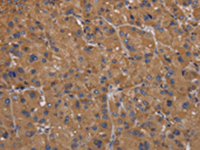 The image on the left is immunohistochemistry of paraffin-embedded Human liver cancer tissue using FADS1 Antibody(FADS1 Antibody) at dilution 1/50, on the right is treated with fusion protein. (Original magnification: ×200)Rabbit anti-Human FADS1 Polyclonal Antibody