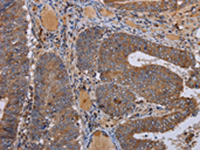 The image on the left is immunohistochemistry of paraffin-embedded Human colon cancer tissue using the antibody Antibody) at dilution 1/50, on the right is treated with fusion protein. (Original magnification: ×200)Rabbit anti-Human FADS1 Polyclonal Antibody