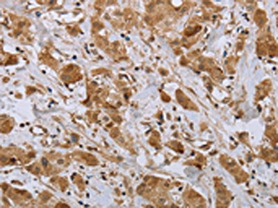 The image on the left is immunohistochemistry of paraffin-embedded Human breast cancer tissue using NPR2 Antibody(NPR2 Antibody) at dilution 1/45, on the right is treated with synthetic peptide. (Original magnification: ×200)Rabbit anti-Human NPR2 Polyclonal Antibody