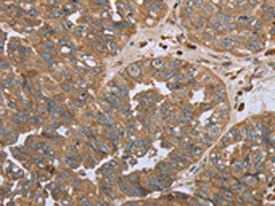 The image on the left is immunohistochemistry of paraffin-embedded Human ovarian cancer tissue using the antibody Antibody) at dilution 1/45, on the right is treated with synthetic peptide. (Original magnification: ×200)Rabbit anti-Human NPR2 Polyclonal Antibody