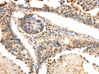The image on the left is immunohistochemistry of paraffin-embedded Human colon cancer tissue using LRP12 Antibody(LRP12 Antibody) at dilution 1/25, on the right is treated with fusion protein. (Original magnification: ×200)