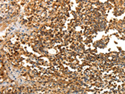 The image on the left is immunohistochemistry of paraffin-embedded Human tonsil tissue using the antibody Antibody) at dilution 1/25, on the right is treated with fusion protein. (Original magnification: ×200)