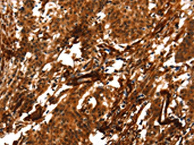 The image on the left is immunohistochemistry of paraffin-embedded Human gastric cancer tissue using ACTA2 Antibody(ACTA2 Antibody) at dilution 1/40, on the right is treated with synthetic peptide. (Original magnification: ×200)