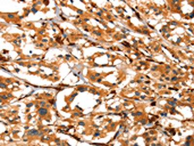 The image on the left is immunohistochemistry of paraffin-embedded Human thyroid cancer tissue using the antibody Antibody) at dilution 1/40, on the right is treated with synthetic peptide. (Original magnification: ×200)
