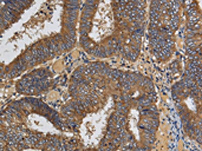The image on the left is immunohistochemistry of paraffin-embedded Human colon cancer tissue using the antibody Antibody) at dilution 1/60, on the right is treated with fusion protein. (Original magnification: ×200)