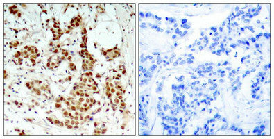 Immunohistochemical analysis of paraffin-embedded human breast carcinoma tissue using p90RSK(Phospho-Thr348) Antibody(left) or the same antibody preincubated with blocking peptide(right).Rabbit anti-Human RPS6KA1 Polyclonal Antibody