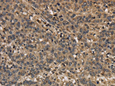 The image on the left is immunohistochemistry of paraffin-embedded Human liver cancer tissue using KCNN4 Antibody(KCNN4 Antibody) at dilution 1/40, on the right is treated with synthetic peptide. (Original magnification: ×200)