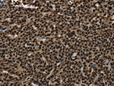 The image on the left is immunohistochemistry of paraffin-embedded Human ovarian cancer tissue using the antibody Antibody) at dilution 1/25, on the right is treated with synthetic peptide. (Original magnification: ×200)Rabbit anti-Human ANP32E Polyclonal Antibody