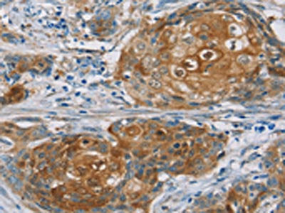 The image on the left is immunohistochemistry of paraffin-embedded Human cervical cancer tissue using RORB Antibody(RORB Antibody) at dilution 1/30, on the right is treated with synthetic peptide. (Original magnification: ×200)Rabbit anti-Human RORB Polyclonal Antibody