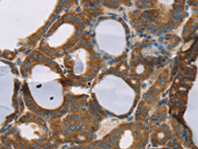 The image on the left is immunohistochemistry of paraffin-embedded Human thyroid cancer tissue using the antibody Antibody) at dilution 1/30, on the right is treated with synthetic peptide. (Original magnification: ×200)Rabbit anti-Human RORB Polyclonal Antibody