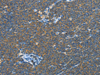The image on the left is immunohistochemistry of paraffin-embedded Human lymphoma tissue using TNFSF13B Antibody(TNFSF13B Antibody) at dilution 1/20, on the right is treated with fusion protein. (Original magnification: ×200)Rabbit anti-Human TNFSF13B Polyclonal Antibody