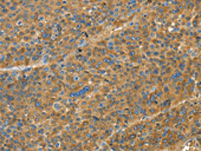 The image on the left is immunohistochemistry of paraffin-embedded Human liver cancer tissue using the antibody Antibody) at dilution 1/20, on the right is treated with fusion protein. (Original magnification: ×200)Rabbit anti-Human TNFSF13B Polyclonal Antibody