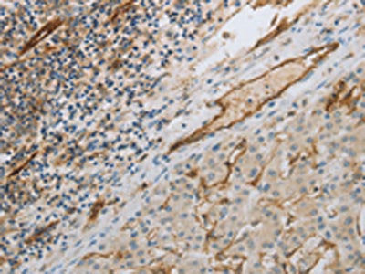 The image on the left is immunohistochemistry of paraffin-embedded Human liver cancer tissue using PECAM1 Antibody(PECAM1 Antibody) at dilution 1/30, on the right is treated with synthetic peptide. (Original magnification: ×200)Rabbit anti-Human PECAM1 Polyclonal Antibody