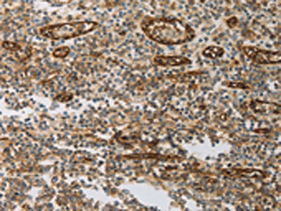 The image on the left is immunohistochemistry of paraffin-embedded Human tonsil tissue using the antibody Antibody) at dilution 1/30, on the right is treated with synthetic peptide. (Original magnification: ×200)Rabbit anti-Human PECAM1 Polyclonal Antibody