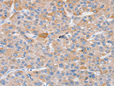The image on the left is immunohistochemistry of paraffin-embedded Human liver cancer tissue using SLC25A13 Antibody(SLC25A13 Antibody) at dilution 1/35, on the right is treated with fusion protein. (Original magnification: ×200)Rabbit anti-Human SLC25A13 Polyclonal Antibody