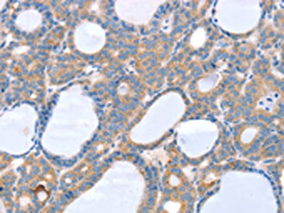 The image on the left is immunohistochemistry of paraffin-embedded Human thyroid cancer tissue using the antibody Antibody) at dilution 1/35, on the right is treated with fusion protein. (Original magnification: ×200)Rabbit anti-Human SLC25A13 Polyclonal Antibody
