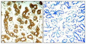 Immunohistochemical analysis of paraffin-embedded human breast carcinoma tissue using Keratin 8(Ab-74) Antibody(left) or the same antibody preincubated with blocking peptide(right).Rabbit anti-Human KRT8 Polyclonal Antibody