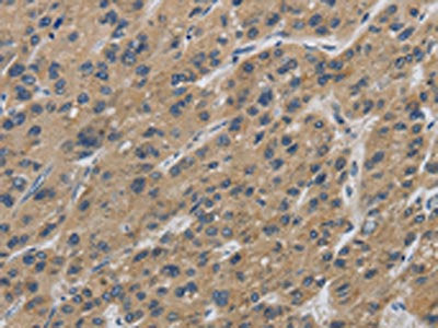 The image on the left is immunohistochemistry of paraffin-embedded Human liver cancer tissue using IPO7 Antibody(IPO7 Antibody) at dilution 1/40, on the right is treated with synthetic peptide. (Original magnification: ×200)