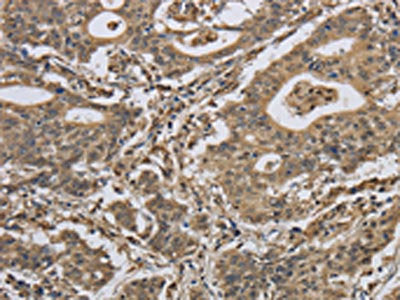 The image on the left is immunohistochemistry of paraffin-embedded Human gastic cancer tissue using the antibody Antibody) at dilution 1/40, on the right is treated with synthetic peptide. (Original magnification: ×200)
