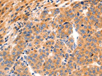 The image on the left is immunohistochemistry of paraffin-embedded Human liver cancer tissue using GRM8 Antibody(GRM8 Antibody) at dilution 1/150, on the right is treated with synthetic peptide. (Original magnification: ×200)Rabbit anti-Human GRM8 Polyclonal Antibody