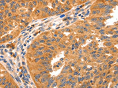 The image on the left is immunohistochemistry of paraffin-embedded Human ovarian cancer tissue using the antibody Antibody) at dilution 1/150, on the right is treated with synthetic peptide. (Original magnification: ×200)Rabbit anti-Human GRM8 Polyclonal Antibody