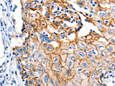 The image on the left is immunohistochemistry of paraffin-embedded Human cervical cancer tissue using CLDN1 Antibody(CLDN1 Antibody) at dilution 1/150, on the right is treated with synthetic peptide. (Original magnification: X200)Rabbit anti-Human CLDN1 Polyclonal Antibody