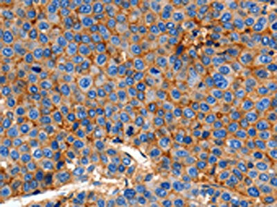 The image on the left is immunohistochemistry of paraffin-embedded Human esophagus cancer tissue using the antibody Antibody) at dilution 1/150, on the right is treated with synthetic peptide. (Original magnification: X200)Rabbit anti-Human CLDN1 Polyclonal Antibody