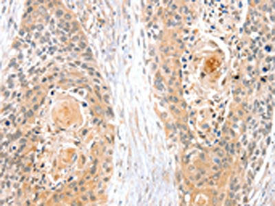 The image on the left is immunohistochemistry of paraffin-embedded Human esophagus cancer tissue using SNX3 Antibody(SNX3 Antibody) at dilution 1/35, on the right is treated with synthetic peptide. (Original magnification: ×200)Rabbit anti-Human SNX3 Polyclonal Antibody