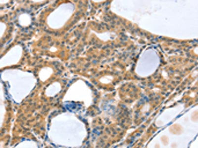 The image on the left is immunohistochemistry of paraffin-embedded Human thyroid cancer tissue using the antibody Antibody) at dilution 1/35, on the right is treated with synthetic peptide. (Original magnification: ×200)Rabbit anti-Human SNX3 Polyclonal Antibody