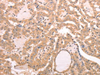 The image on the left is immunohistochemistry of paraffin-embedded Human thyroid cancer tissue using the antibody Antibody) at dilution 1/30, on the right is treated with fusion protein. (Original magnification: ×200)
