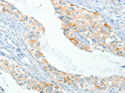 The image on the left is immunohistochemistry of paraffin-embedded Human cervical cancer tissue using the antibody Antibody) at dilution 1/80, on the right is treated with synthetic peptide. (Original magnification: ×200)Rabbit anti-Human APOL2 Polyclonal Antibody