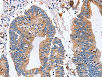 The image on the left is immunohistochemistry of paraffin-embedded Human colon cancer tissue using SIGLEC6 Antibody(SIGLEC6 Antibody) at dilution 1/70, on the right is treated with synthetic peptide. (Original magnification: ×200)