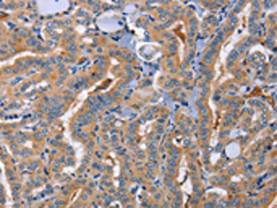 The image on the left is immunohistochemistry of paraffin-embedded Human thyroid cancer tissue using the antibody Antibody) at dilution 1/70, on the right is treated with synthetic peptide. (Original magnification: ×200)