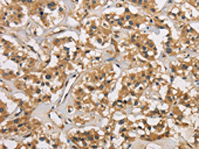 The image is immunohistochemistry of paraffin-embedded Human thyroid cancer tissue using CASP3 Antibody(CASP3 Antibody) at dilution 1/30. (Original magnification: ×200)