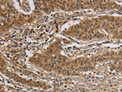 The image is immunohistochemistry of paraffin-embedded Human gastric cancer tissue using the antibody Antibody) at dilution 1/30. (Original magnification: ×200)