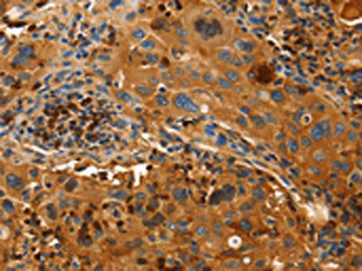 The image on the left is immunohistochemistry of paraffin-embedded Human lung cancer tissue using ORM2 Antibody(ORM2 Antibody) at dilution 1/50, on the right is treated with fusion protein. (Original magnification: ×200)Rabbit anti-Human ORM2 Polyclonal Antibody