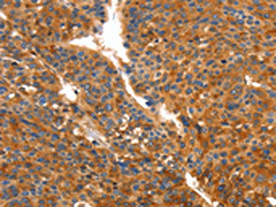 The image on the left is immunohistochemistry of paraffin-embedded Human liver cancer tissue using the antibody Antibody) at dilution 1/50, on the right is treated with fusion protein. (Original magnification: ×200)Rabbit anti-Human ORM2 Polyclonal Antibody