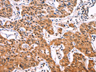 The image on the left is immunohistochemistry of paraffin-embedded Human lung cancer tissue using IL1RL1 Antibody(IL1RL1 Antibody) at dilution 1/70, on the right is treated with fusion protein. (Original magnification: ×200)
