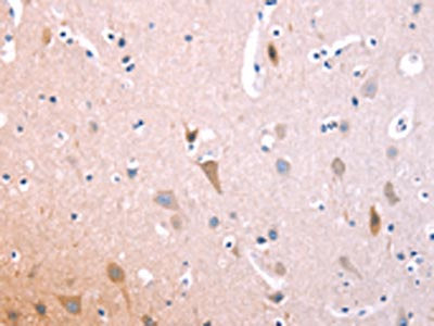 The image on the left is immunohistochemistry of paraffin-embedded Human brain tissue using the antibody Antibody) at dilution 1/70, on the right is treated with fusion protein. (Original magnification: ×200)