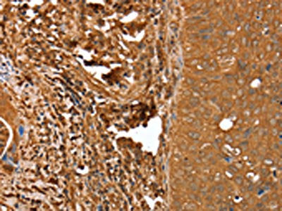The image on the left is immunohistochemistry of paraffin-embedded Human cervical cancer tissue using CNN3 Antibody(CNN3 Antibody) at dilution 1/25, on the right is treated with fusion protein. (Original magnification: ×200)Rabbit anti-Human CNN3 Polyclonal Antibody