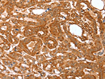 The image on the left is immunohistochemistry of paraffin-embedded Human thyroid cancer tissue using the antibody Antibody) at dilution 1/25, on the right is treated with fusion protein. (Original magnification: ×200)Rabbit anti-Human CNN3 Polyclonal Antibody