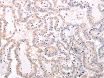The image on the left is immunohistochemistry of paraffin-embedded Human thyroid cancer tissue using the antibody Antibody) at dilution 1/70, on the right is treated with fusion protein. (Original magnification: ×200)Rabbit anti-Human TRAF3IP1 Polyclonal Antibody
